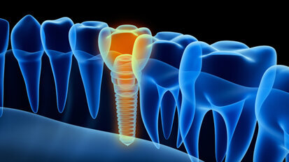 Ceramic implants: What benefits do they offer?