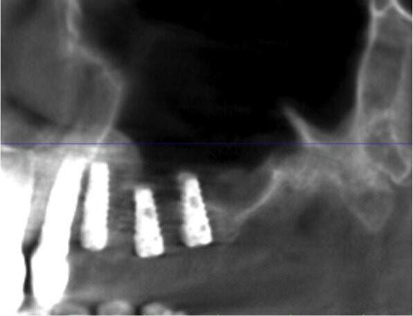 Fig. 13 - Sezione panorex post-operatoria: si noti il sollevamento della membrana di Schneider sugli impianti.