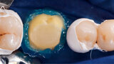 Fig. 6. Grabado de esmalte antes de la aplicación del adhesivo.