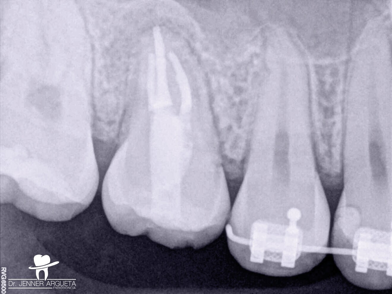 Fig. 9 : Radiographie finale du traitement endocanalaire et de la restauration coronaire. La mise en place du matériau d’obturation coronaire dans la cavité pulpaire tend à être complexe en présence d’un puits d’accès de si petite taille. 