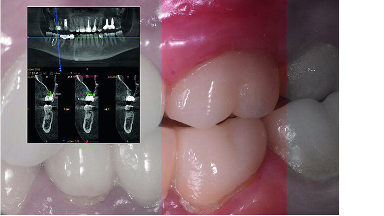 Digital workflow and application of PRF and ozone therapy in oral rehabilitation