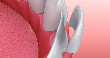 Zahnarzt testet Veneers von Amazon