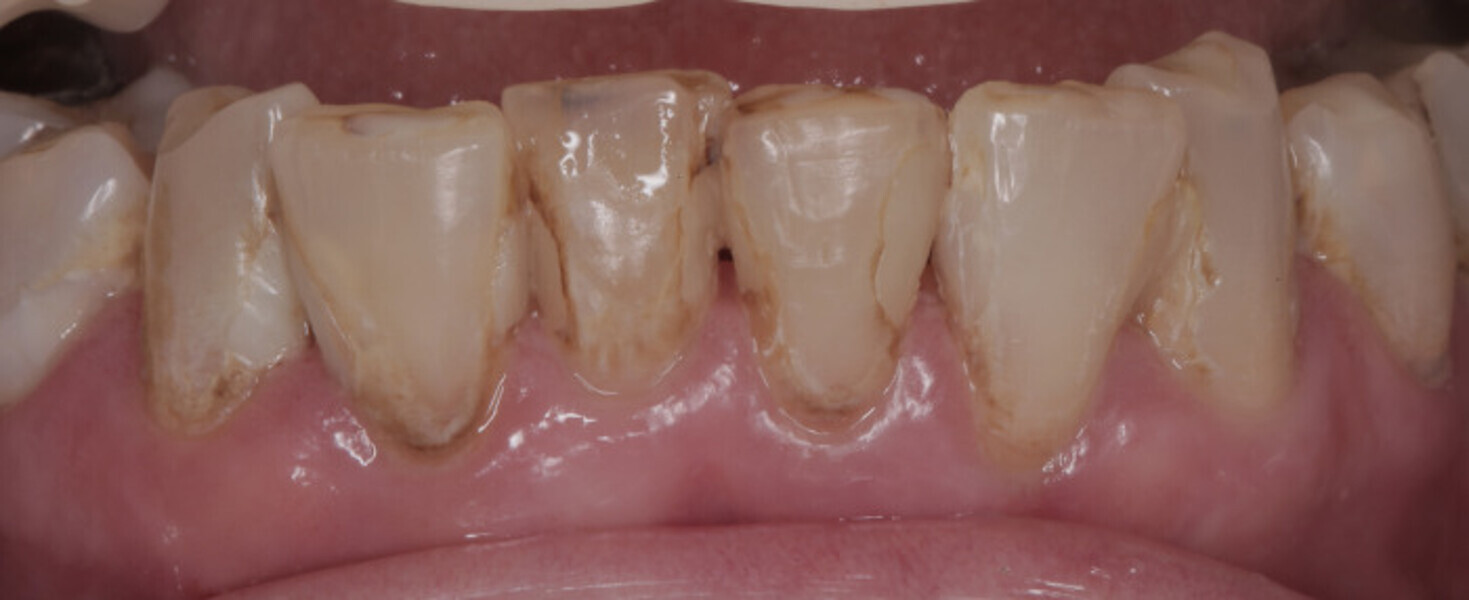 Fig. 4a: Mandibular anterior teeth at initial presentation (a) and after caries removal and injection moulding (b).