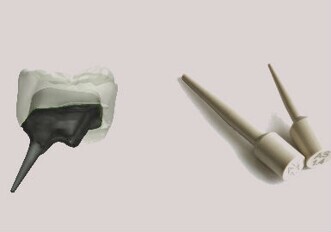 3Shape – Post and Core