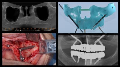 Rehabilitación del maxilar con implantes cigomáticos en paciente de edad avanzada