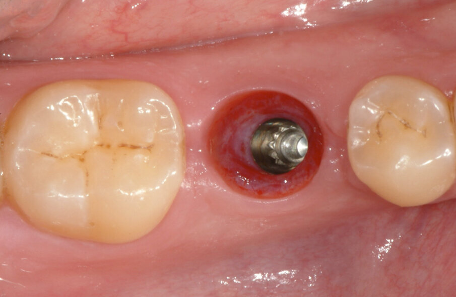 Fig. 9: The healing abutment was removed after six weeks, and a final impression of the implant position
and the shape of the soft tissue was sent, together with the opposing model, to the dental laboratory.