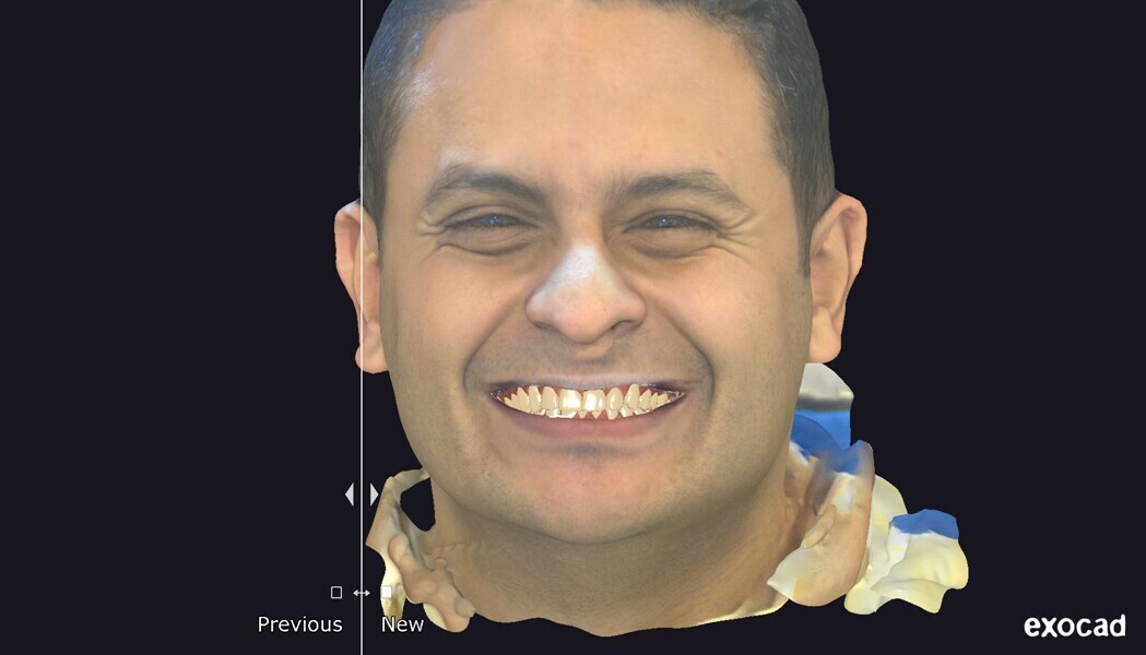 Fig. 7: The final smile simulation, aligned with the facial scan, shows an integrated aesthetic outcome in harmony with the patient’s natural expressions.
