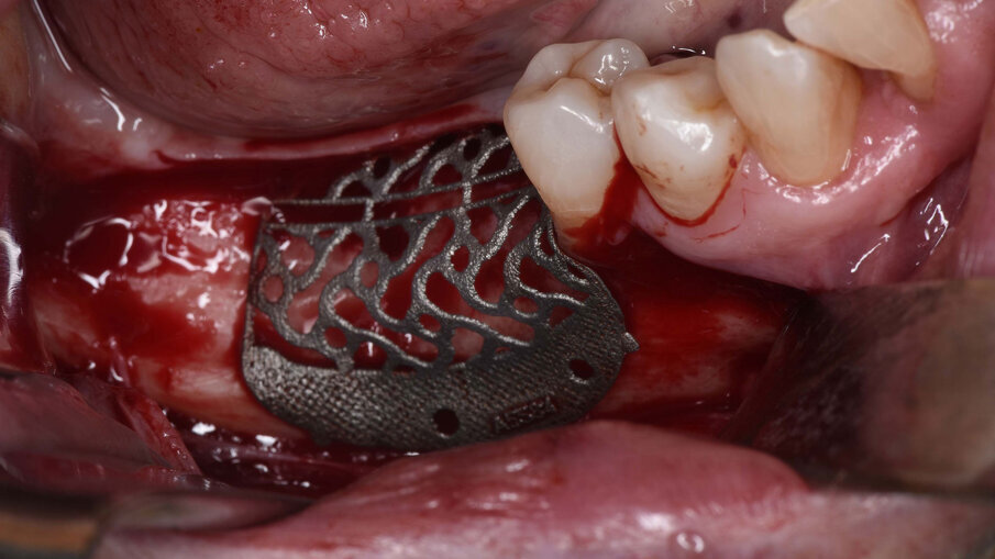 Fig. 4_Visione intra-operatoria della griglia posizionata nel sito da rigenerare e che mostra il difetto osseo prima del suo riempimento.