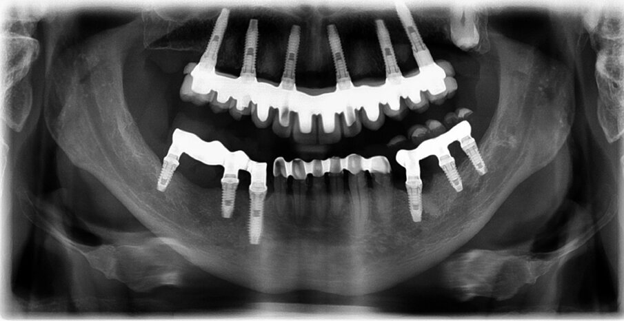 Fig. 21: Radiograph after treatment.
