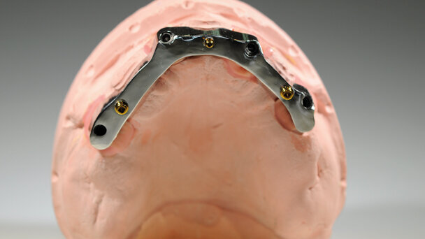 Overdenture su barra implanto-supportata