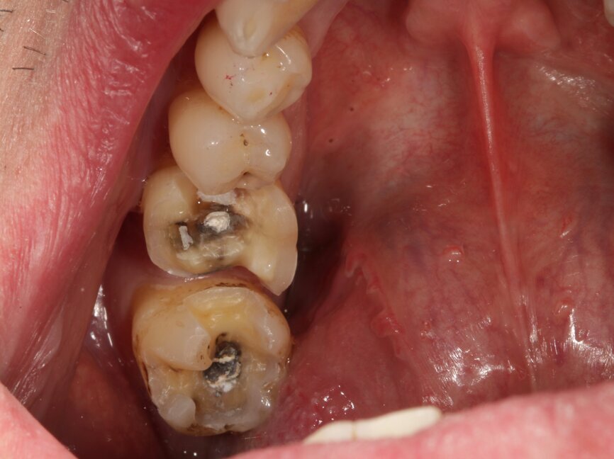 Fig. 3c: The
prepared teeth are readied for intraoral digitalisation (intraoral scanning).