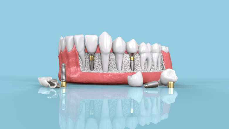 Researchers review dental implant placement using flapless versus flapped technique