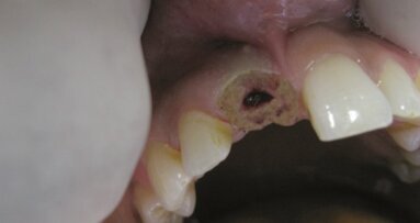 Osteointegracja przy pomocy lasera diodowego w implantacji natychmiastowej