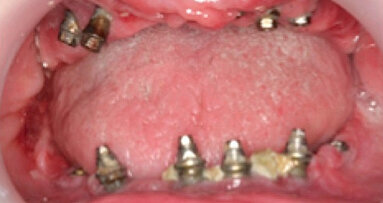 Actualización sobre enfermedades periimplantarias