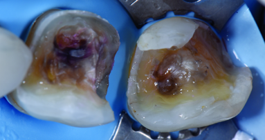 Complex direct ORMOCER composite restorations in the posterior region