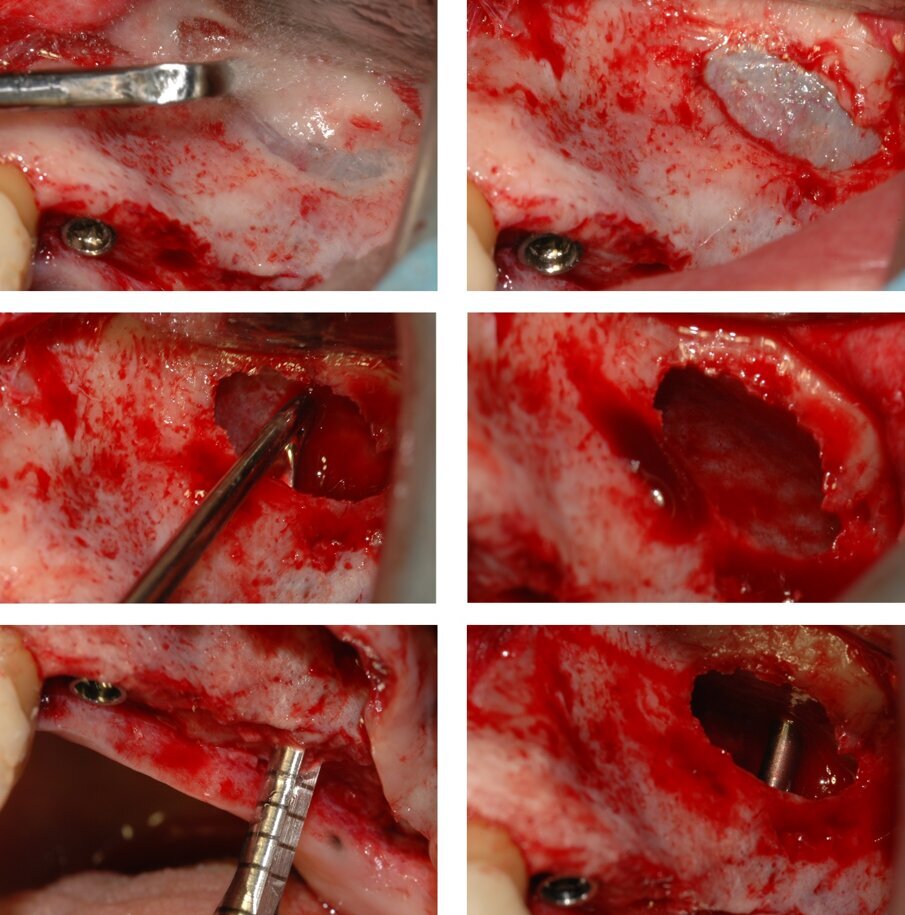 Fig.4_Esecuzione dell’antrostomia, sollevamento della membrana sinusale e preparazione del terzo sito implantare in posizione 2.7. Anche in questo caso, la preparazione del sito implantare è preceduta dalla misura quantitativa della densità ossea (non mostrato). 