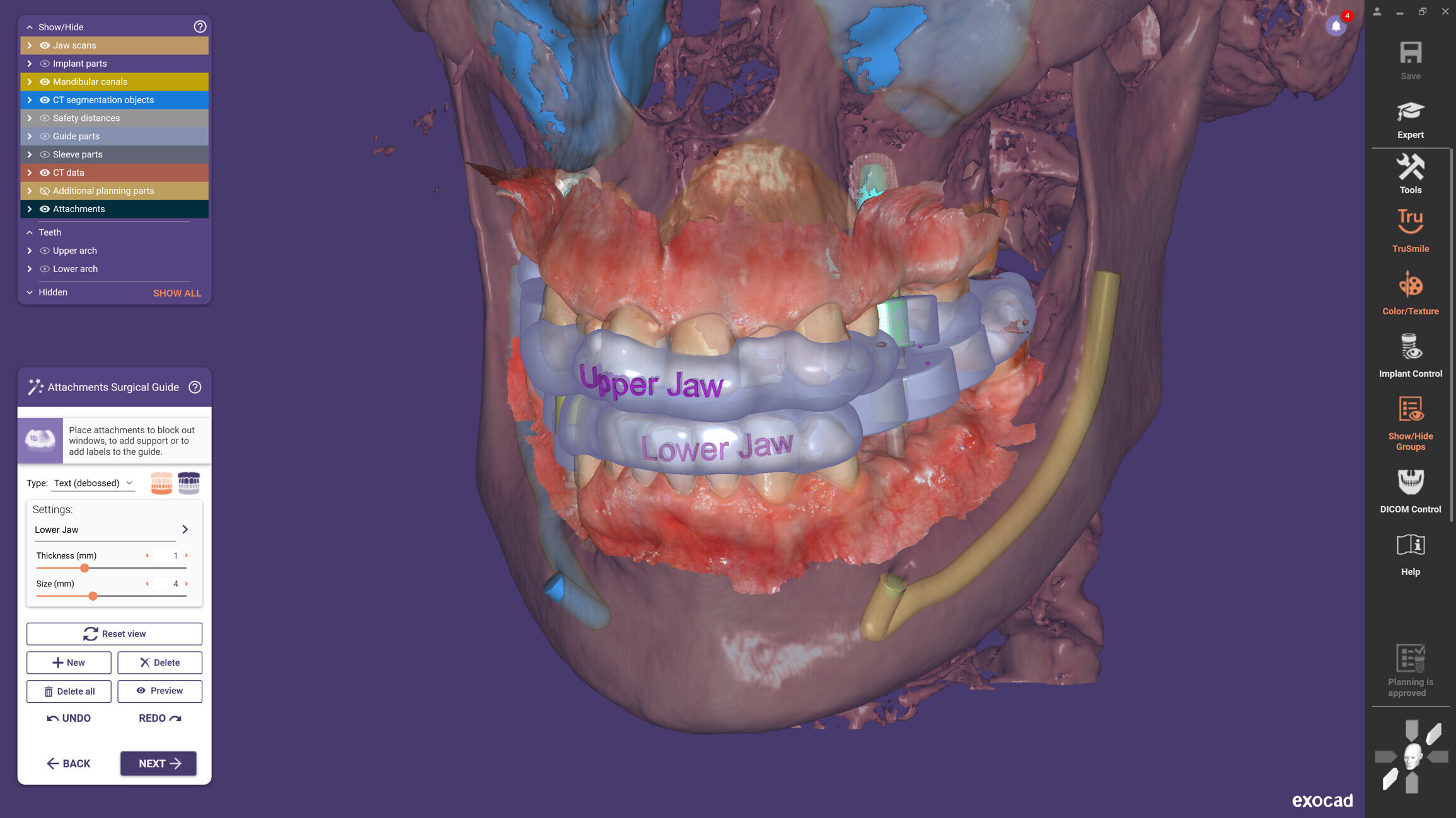 Dental News - Exocad releases new versions of its chairside and implant ...