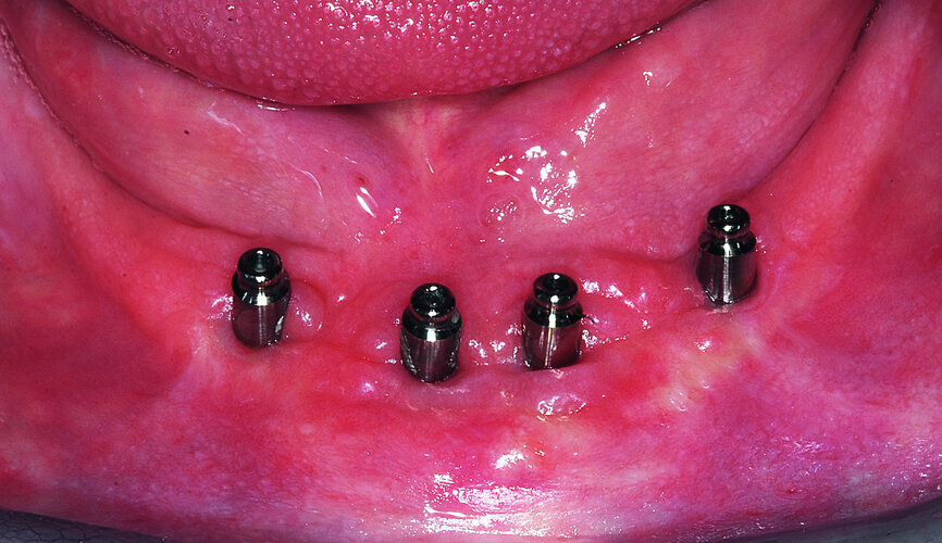 Fig. 20: Four overdenture attachments to support a complete mandibular denture.