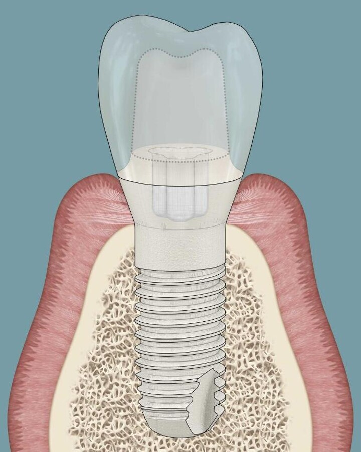 Pas de pÃ©ri-implantite autour dâun systÃ¨me dâimplant en deux piÃ¨ces : plus de preuves Ã  long terme 