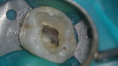 Twisted Files changed the world of endodontics - case report