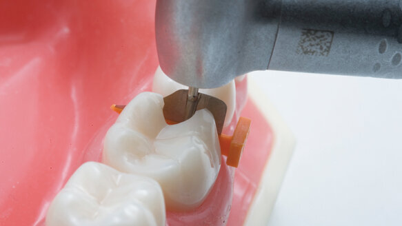 Fenderwedge protects the adjacent teeth