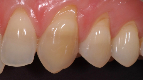Fig. 1: Small areas of cervical loss of enamel, resulting in exposure of dentine to evocative stimuli, in particular cold and air, and thus dentine hypersensitivity pain.