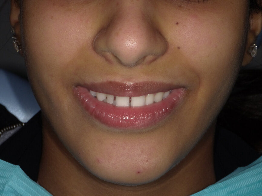 Fig 3: Smile after removal of old restorations