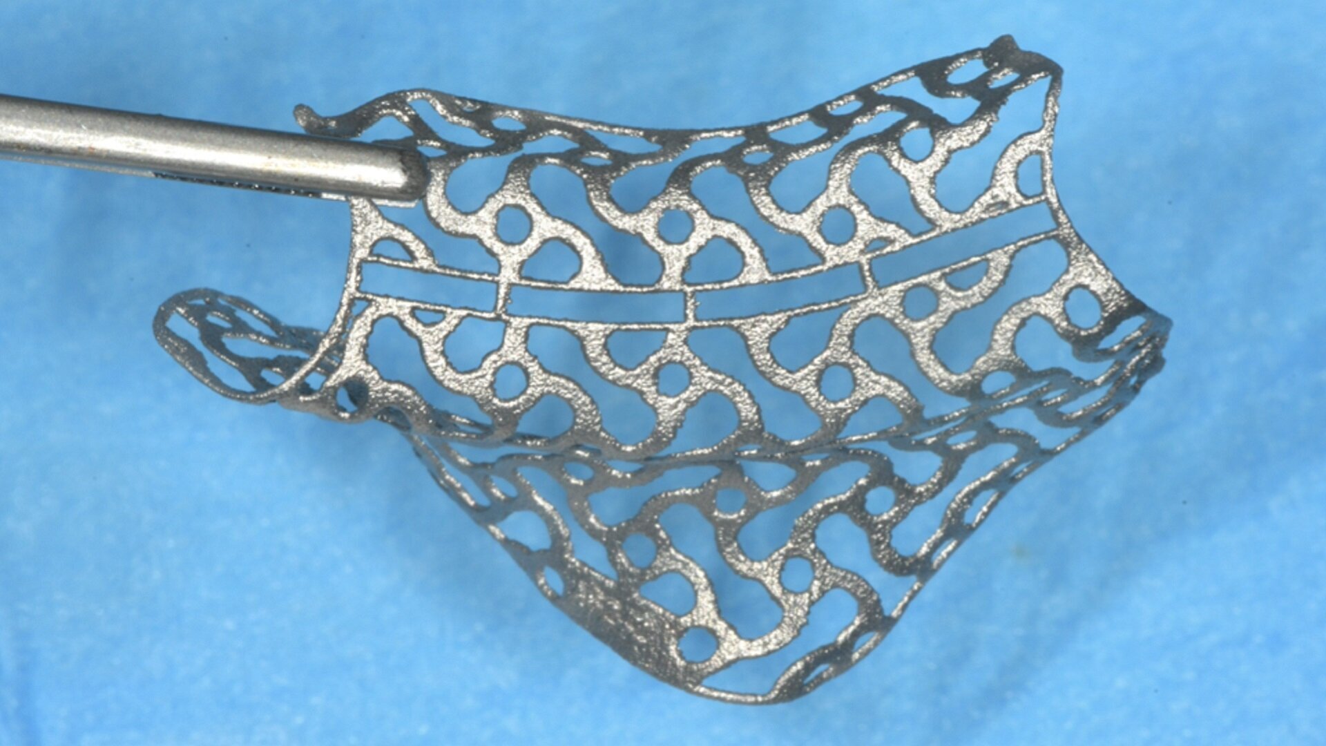 Vertical ridge augmentation using a customised CAD/CAM titanium mesh