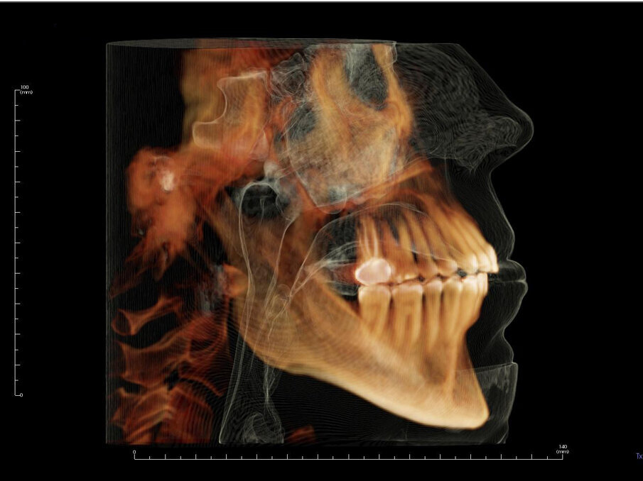 Day of removal