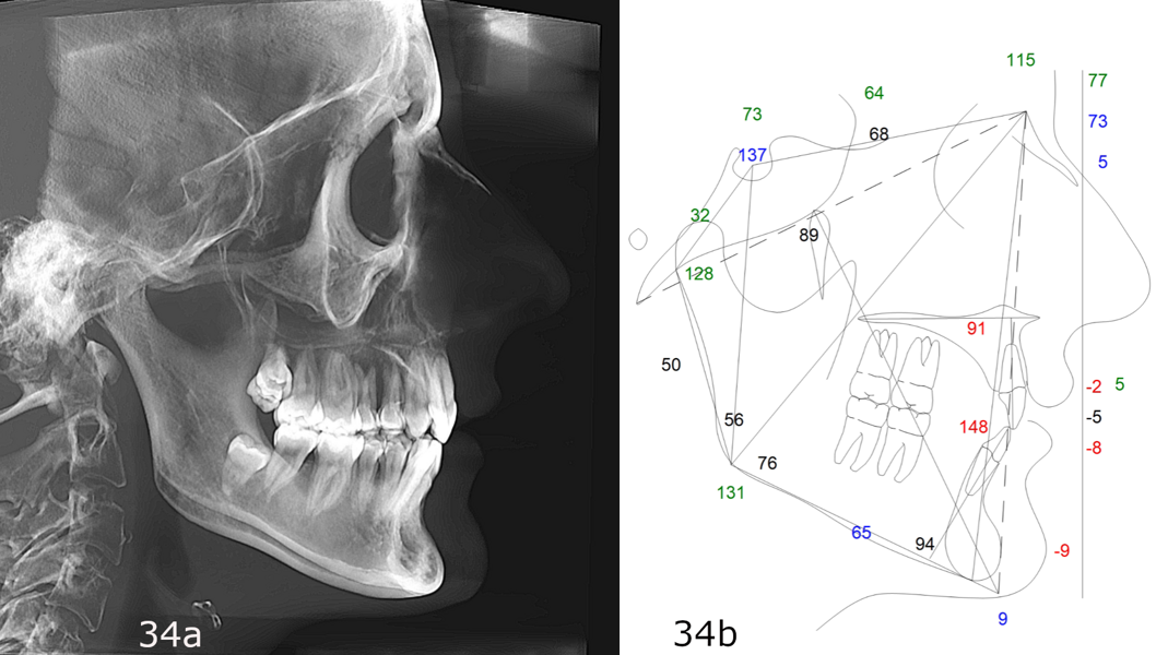 Figs. 34a & b: (a) Cephalometric radiograph and (b) tracing.