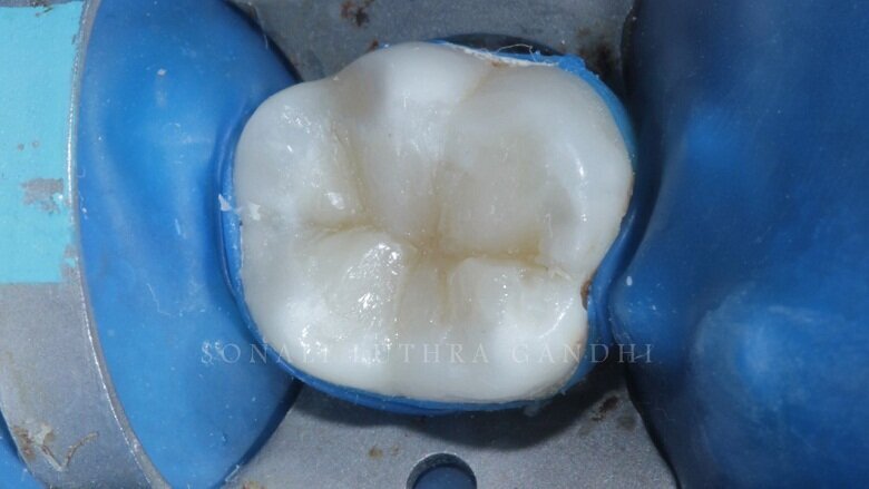 Fig 13: Distal Cusp