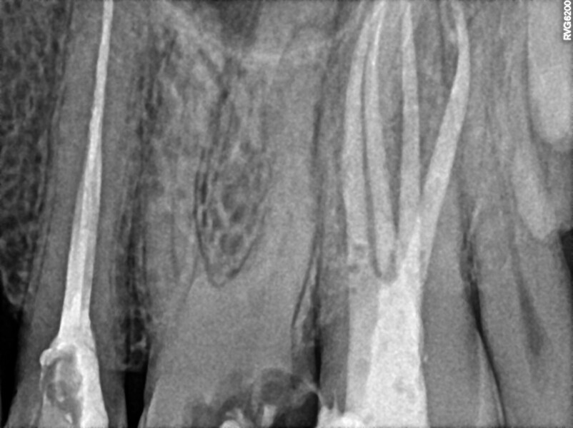 Fig. 47: Pre-op radiograph showing the pulp chamber calcification.
