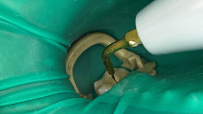 Consigli pratici per un trattamento endodontico affidabile