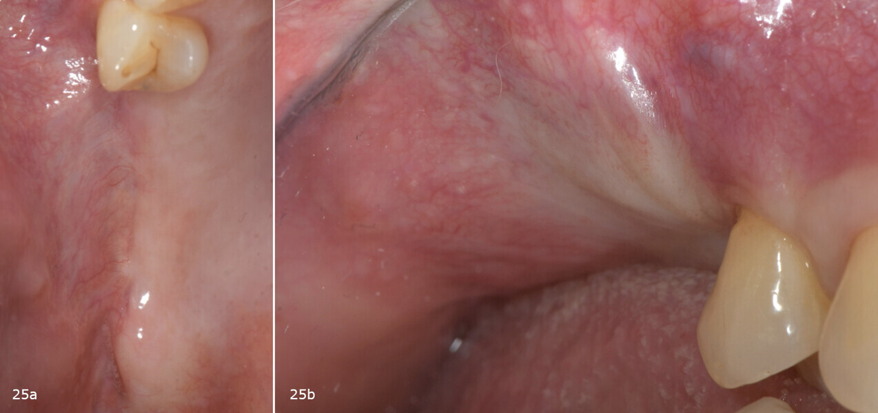 Fig. 25a & b