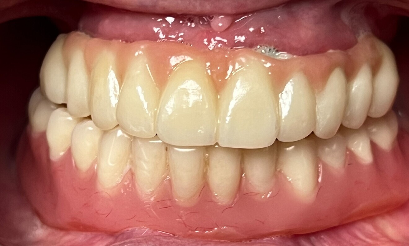 Fig. 2: Intra-oral photograph of the initial situation.