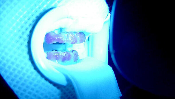 La blancorexia o la obsesión por los dientes blancos