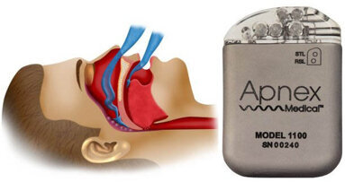 Nieuwe tongpacemaker voorkomt apneu