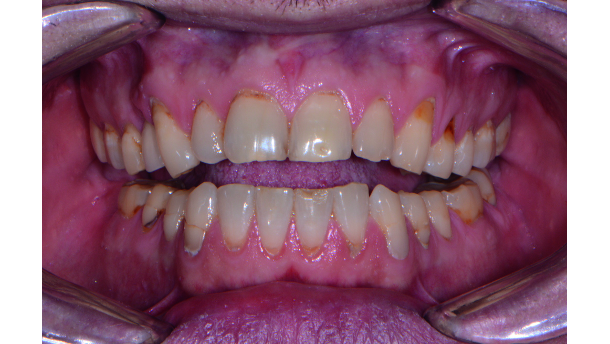 Digital planning for full mouth reconstruction