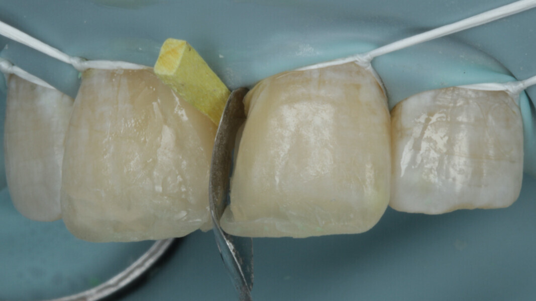 Fig 14. Band and wedge is then stabilized for the left central incisor.