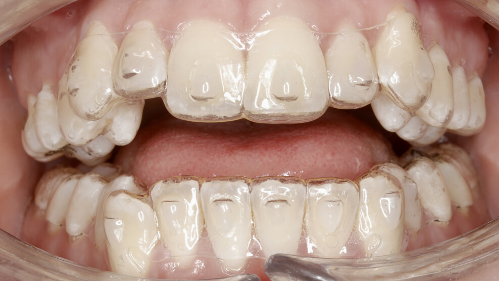 Figs. 4a–c: Intra-oral photographs illustrating the progress of the aligner treatment during the first set of aligners.