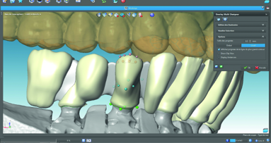 Adaptation of traditional working methods to the creation of Cr-Co ceramic restoration with CAD/CAM technology