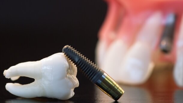 Proste i zaawansowane sposoby leczenia periimplantitis