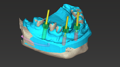 coDiagnostiX implant placement