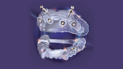 exocad – exoplan