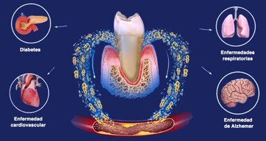 De las encías al cerebro: la conexión oculta entre Alzheimer y Periodontitis