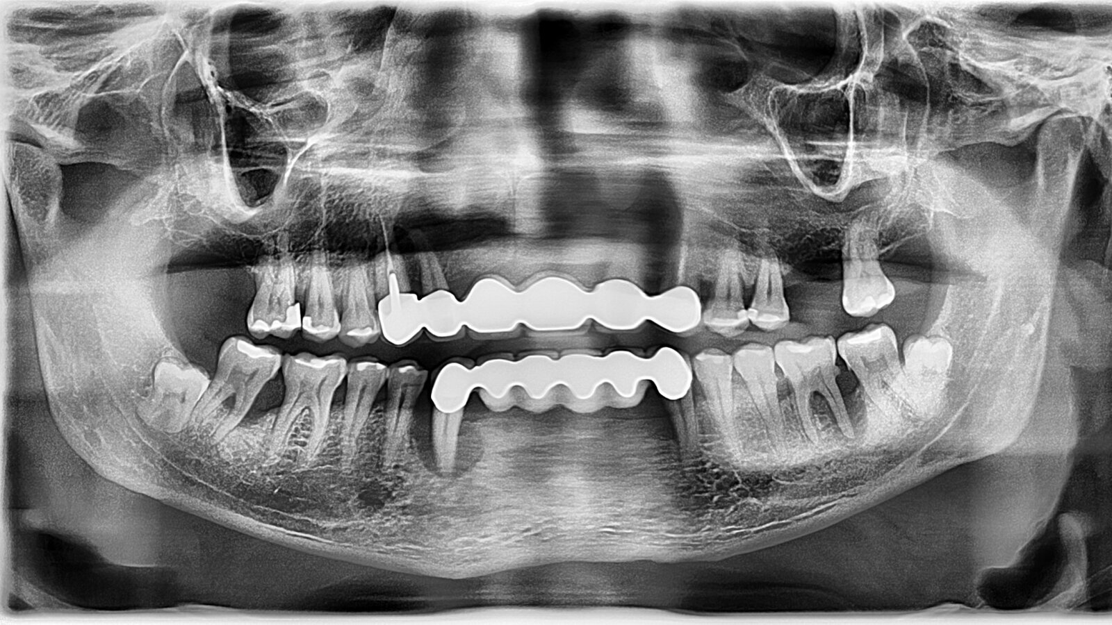 Treatment of patients with severe periodontal disease in general dental practice