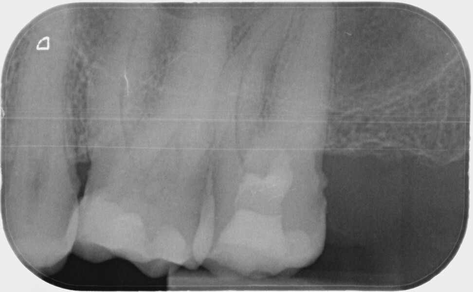Fig. 5 : Radiographie postopératoire.