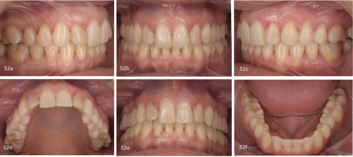 Figs. 52a–f: Post-treatment intra-oral photographs.