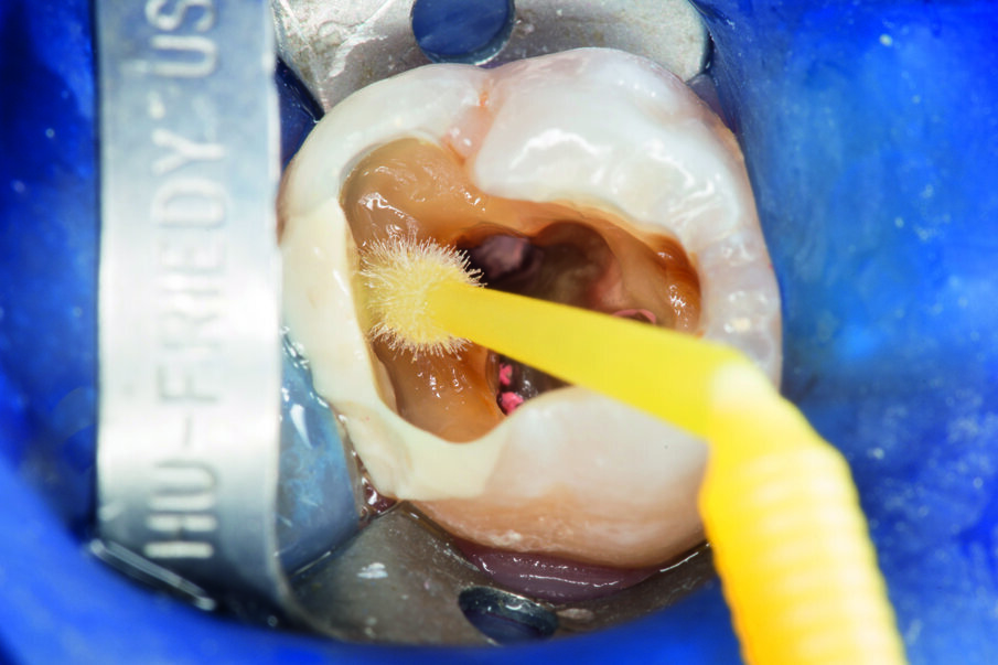 Fig. 3: Application of the etch&rinse adhesive Prime&Bond Universal™