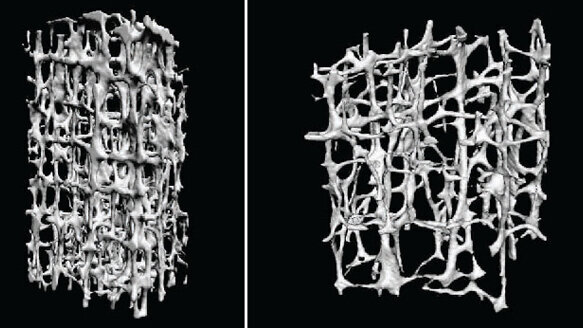 Osteoporosis and bisphosphonates